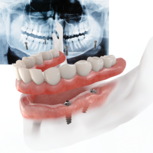 Module Planification Dun Plan De Traitement Implantaire Dentisquare